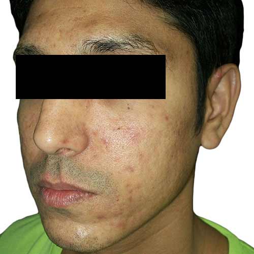 acne_scar_reduction_3_before