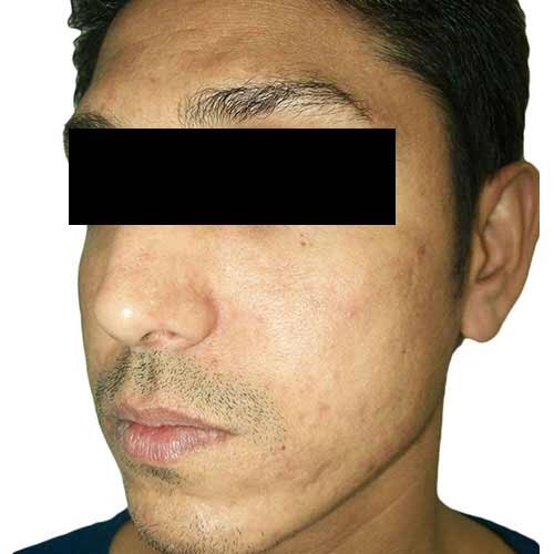 acne_scar_reduction_3_after
